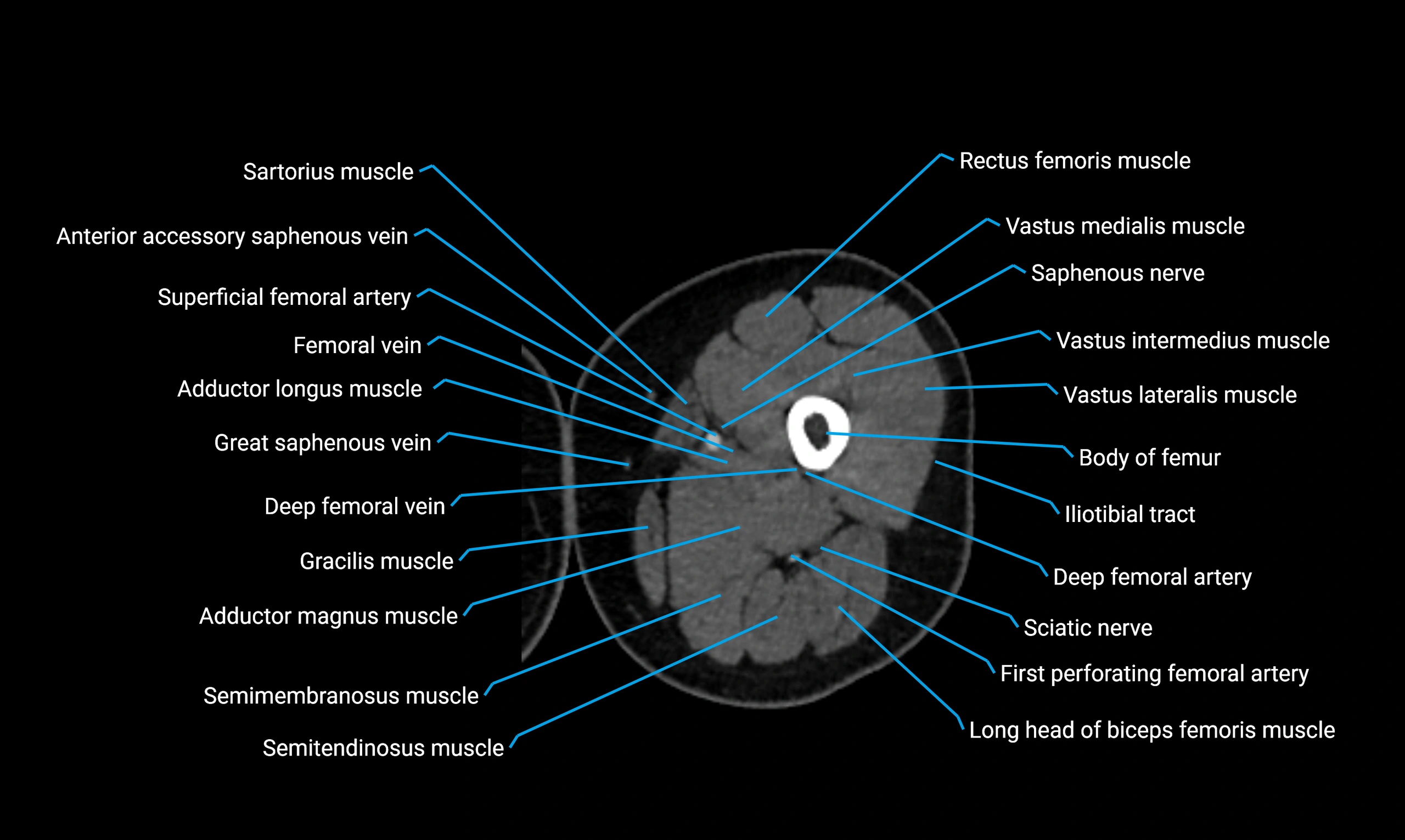 CT thigh axial cross sectional anatomy labelled image_48 (2).webp
